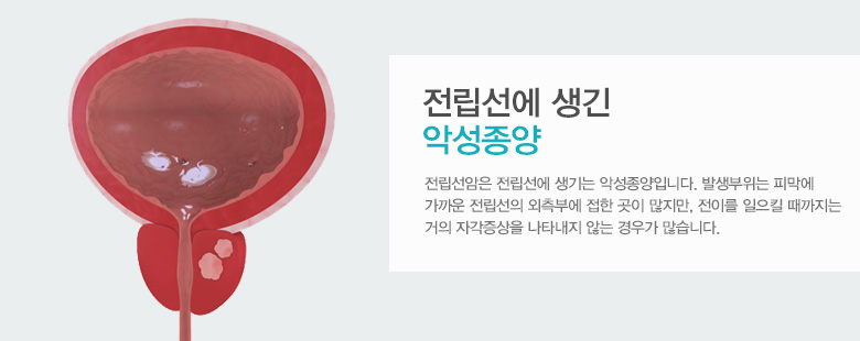 전립선에 생긴 악성종양