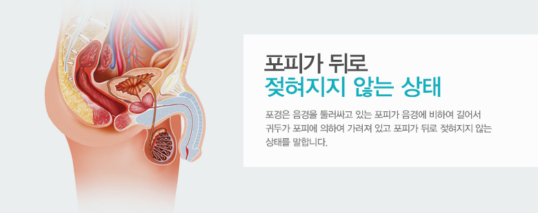 포피가 뒤로 젖혀지지 않는 상태